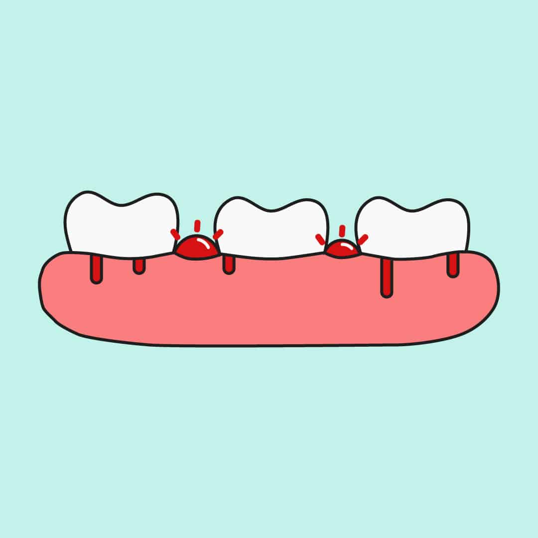 gingivitis bad breath