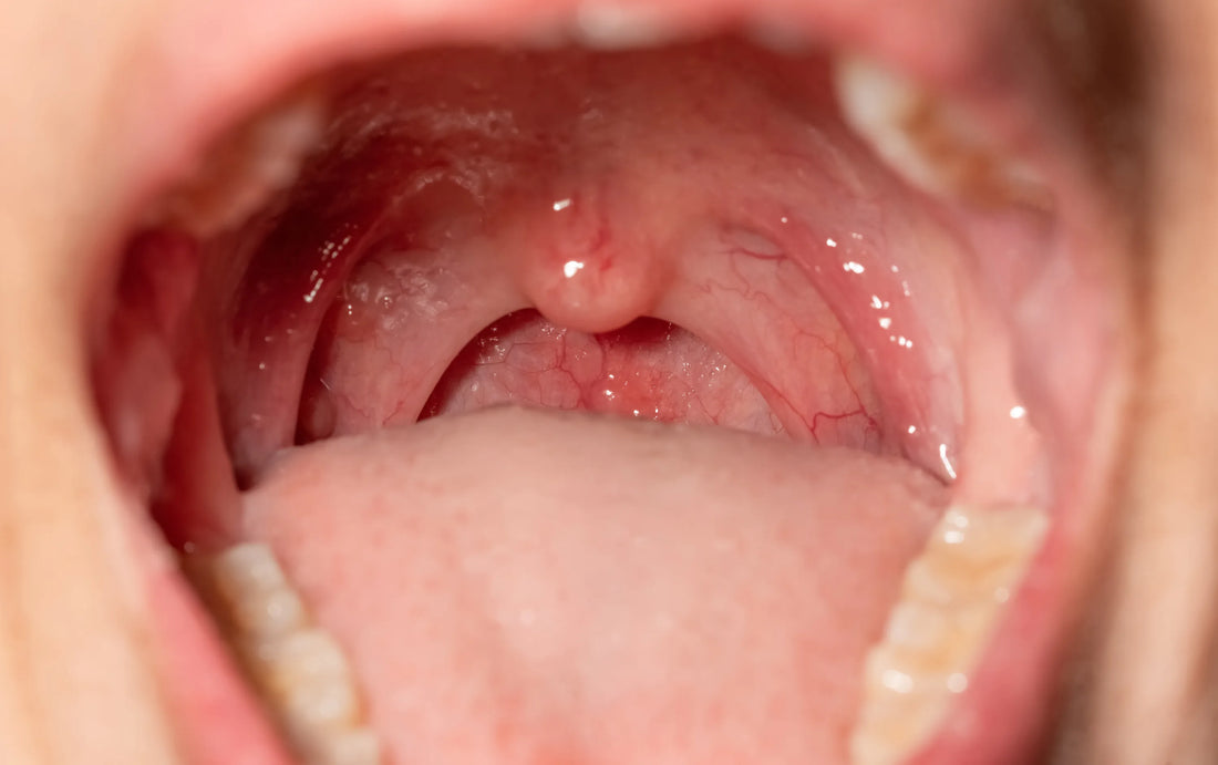 Best Mouthwash for Tonsil Stones: Managing the Smell, Understanding the Cause